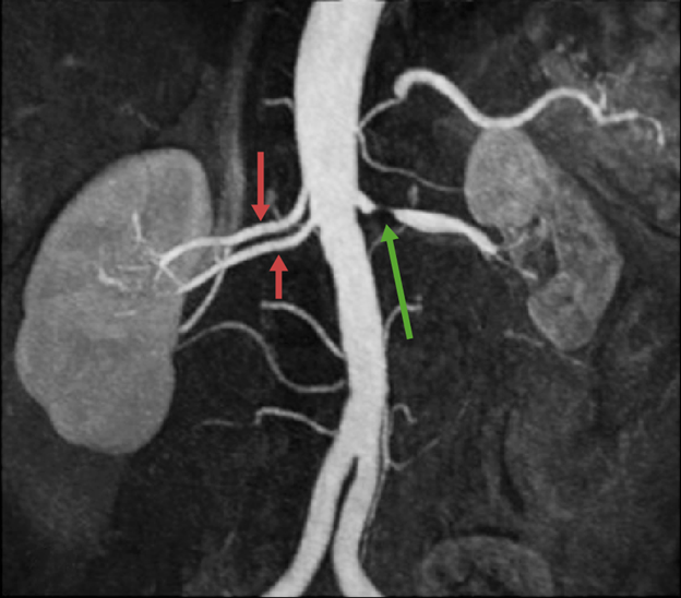 renal artery