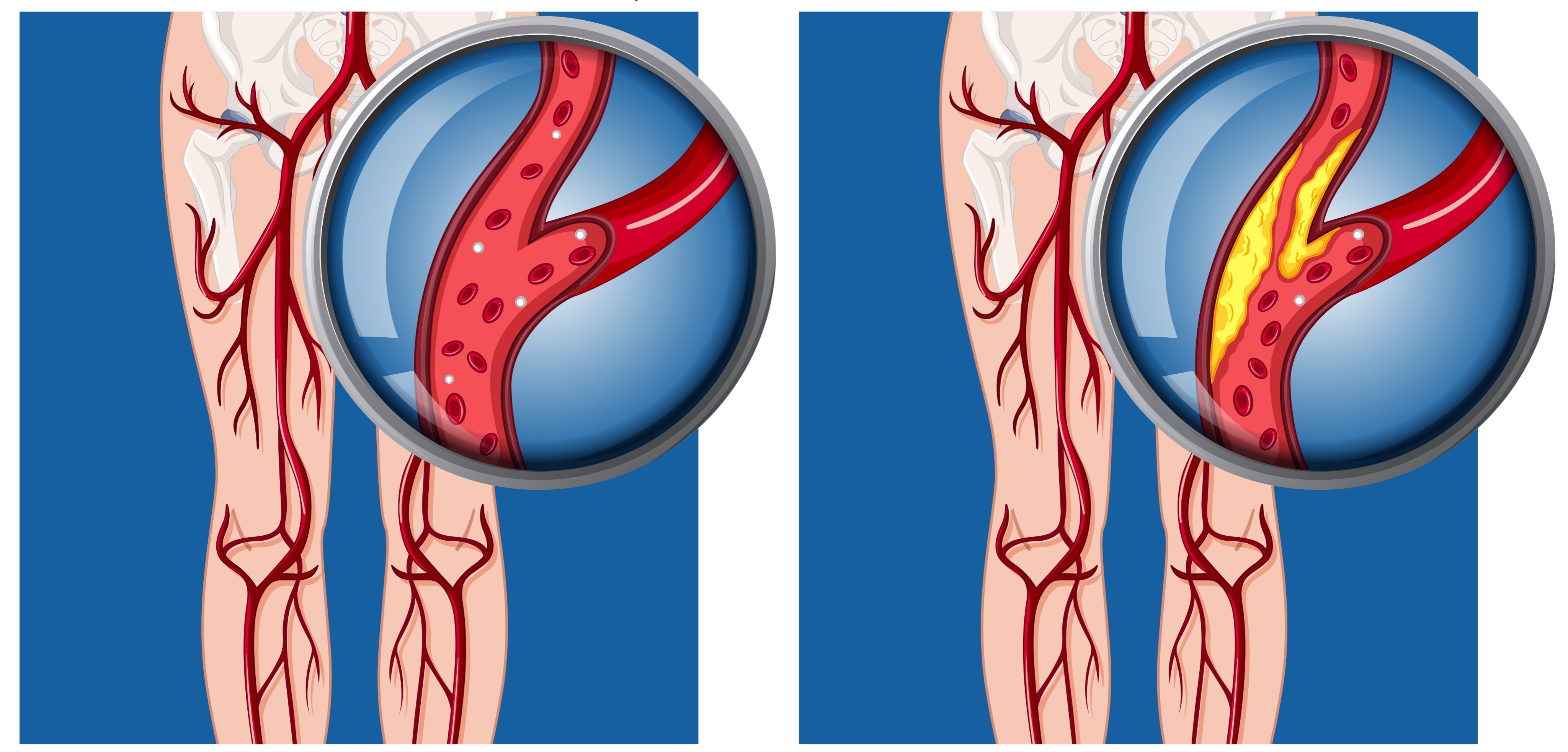 
Lower Extremity Bypass for Peripheral Artery Disease – Indications and What to Expect 