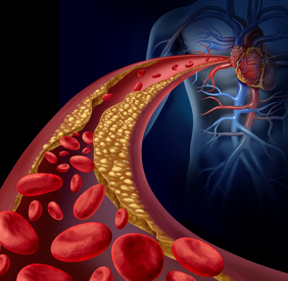 renal-artery-stenosis