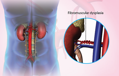 Fibromuscular Dysplasia