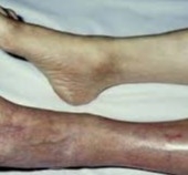 
Acute Limb Ischemia 
