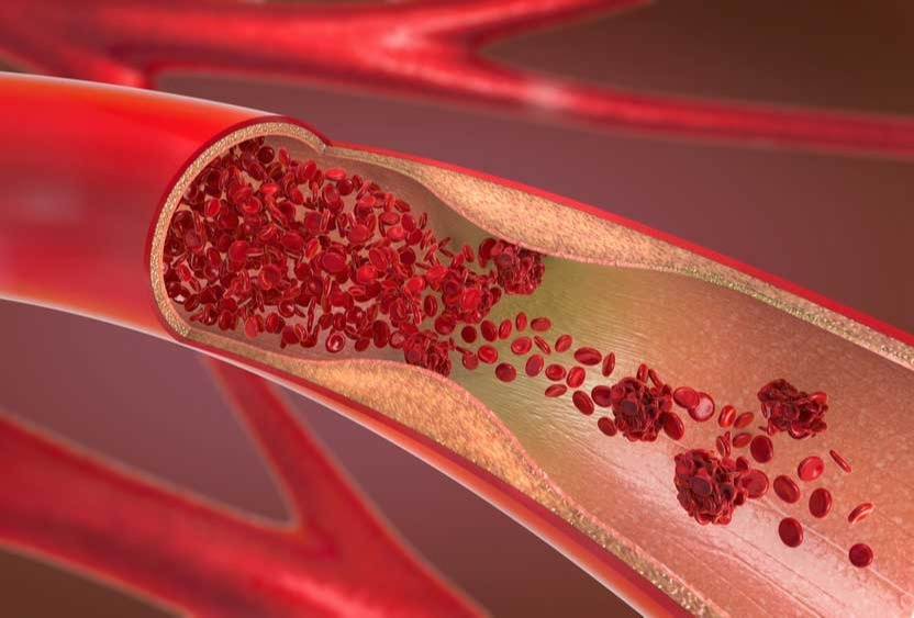 
Common Causes and Symptoms of Blood Clots