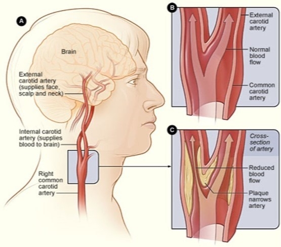 
Carotid Artery Stenosis 