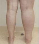
Lymphedema Treatment | Vascular Institute of the Rockies 