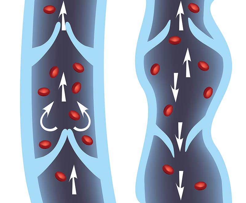 What You Need to Know About Chronic Venous Disease - Tactile Medical