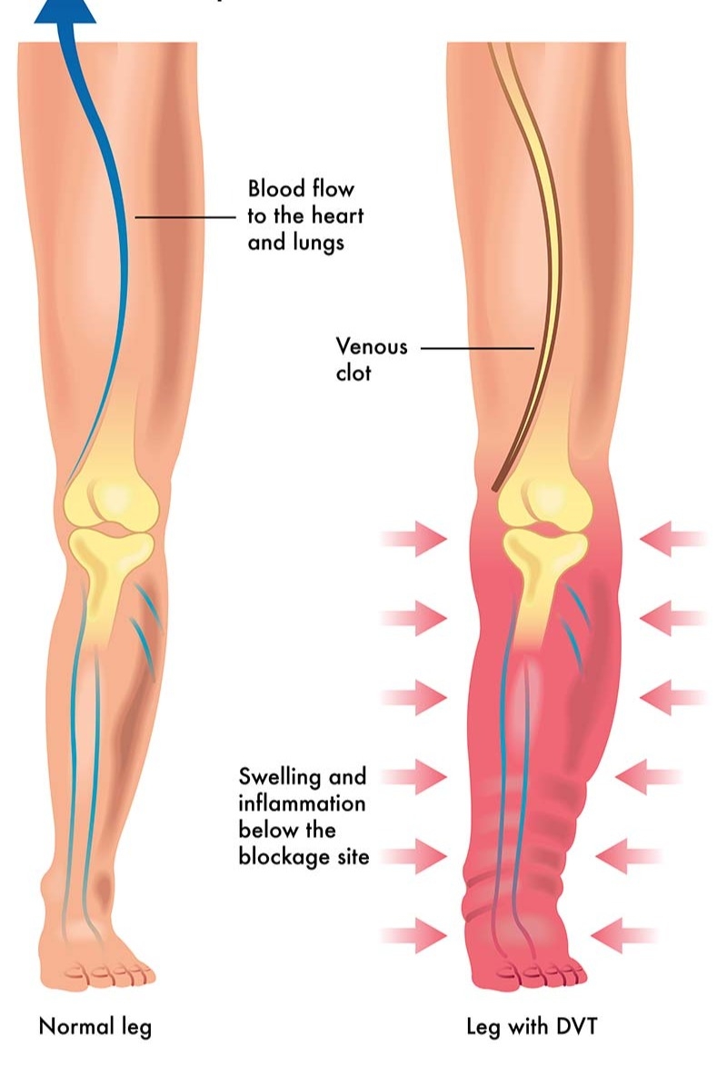 arterial thrombosis vs venous thrombosis