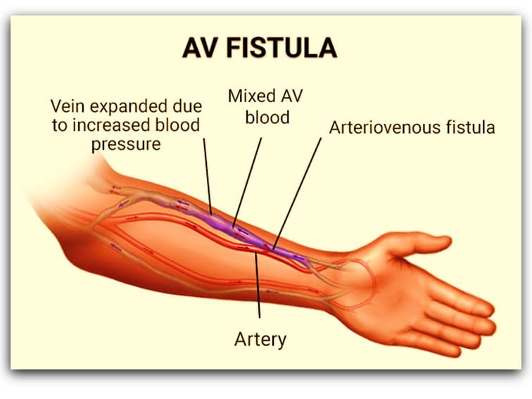 Diagram of an arm showing what an AV Fistula is.
