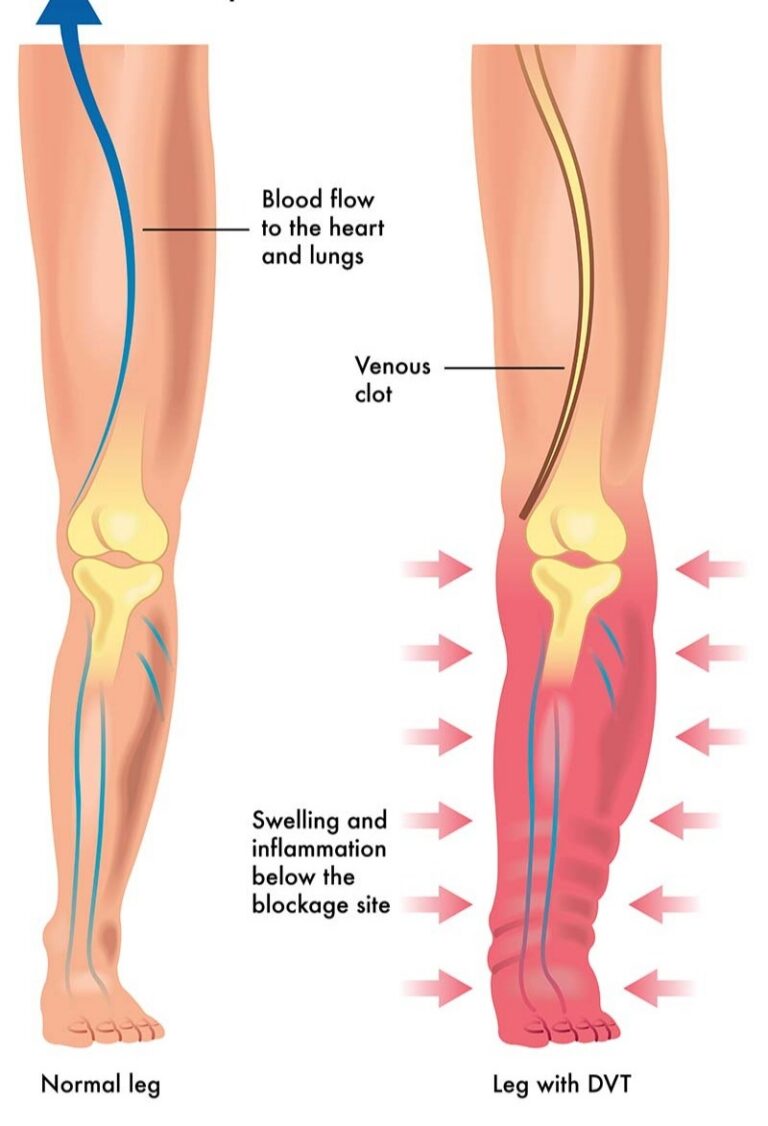 Animated comparison of a normal leg versus a leg swelling due to DVT.