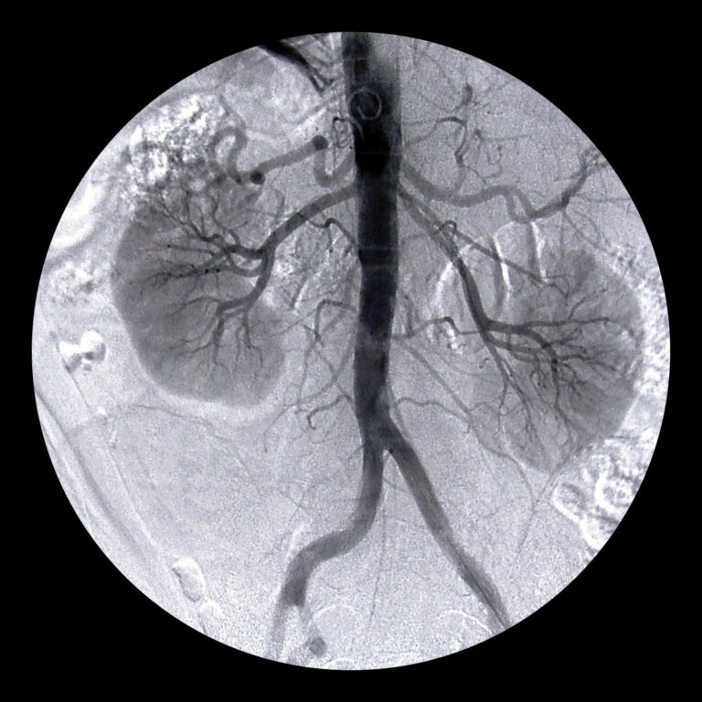 What are the Complications of Endovascular Aneurysm Repair?