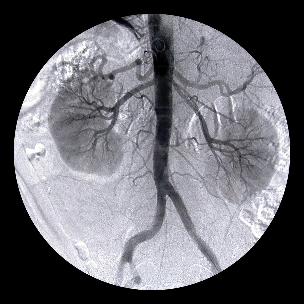 X-ray scan of EVAR.