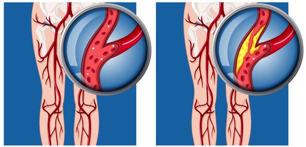 Color chart showing a lower extremity bypass.