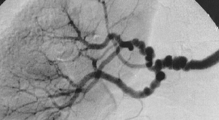 Who Is Most at Risk for Fibromuscular Dysplasia?