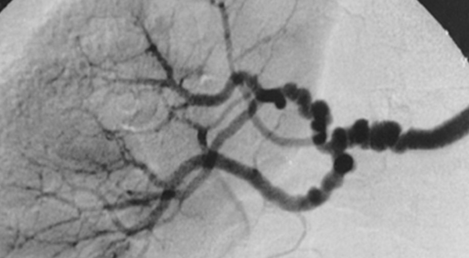 X-ray scan of unhealthy blood vessels due to fibromuscular dysplasia.