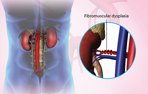 FMDisplasia animated on a color chart shown in the torso.
