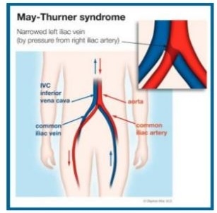 Diagram explaining May-Thurner Syndrome