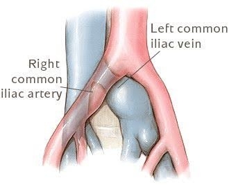Animated view of right and left common arteries for May-Thurner Syndrome.