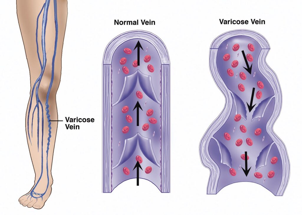 Animated comparison of leg veins differentiating a normal vein from a varicose vein.
