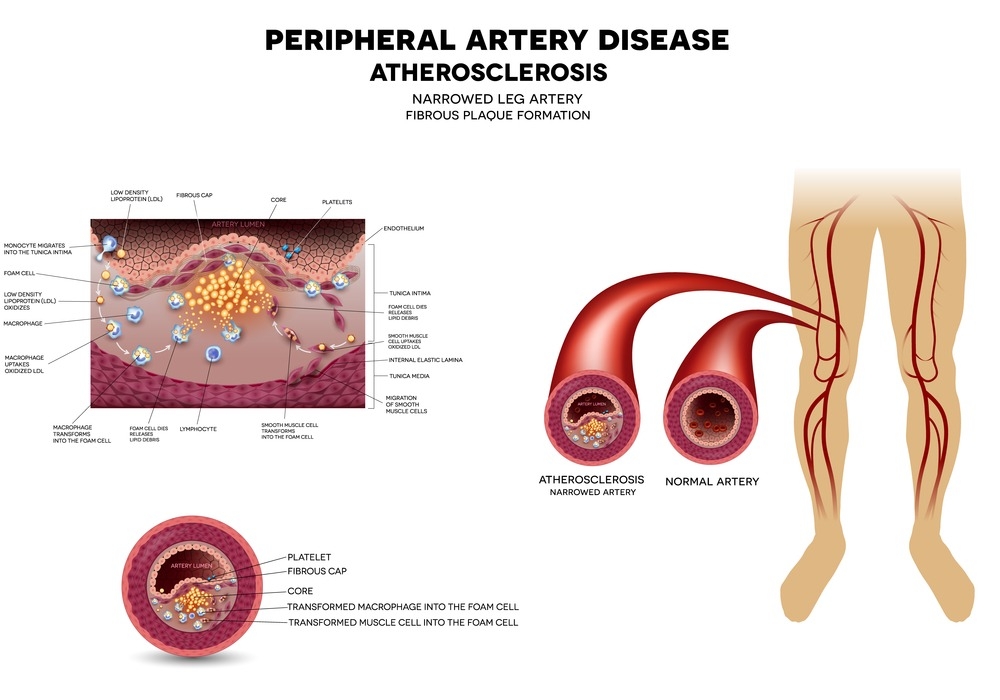 PAD chart comparing condition to normal veins.