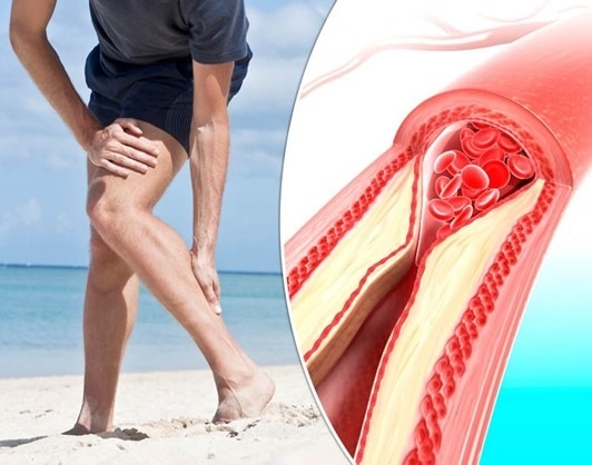 What Happens if Peripheral Arterial Disease is Left Untreated?