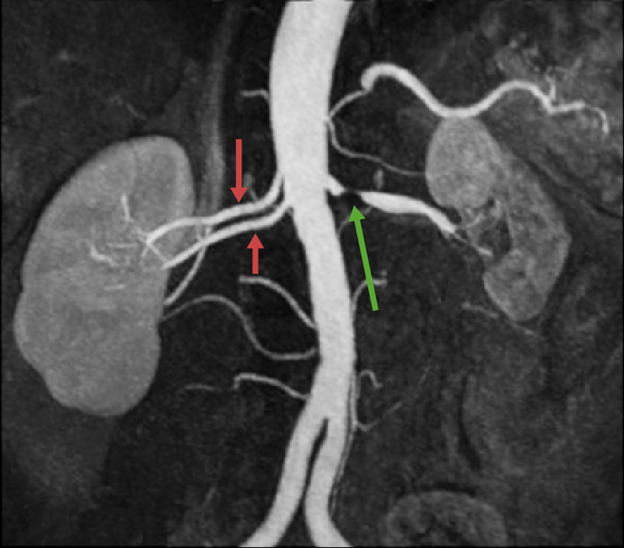 Black and white x-ray view of human kidneys with renal artery stenosis.