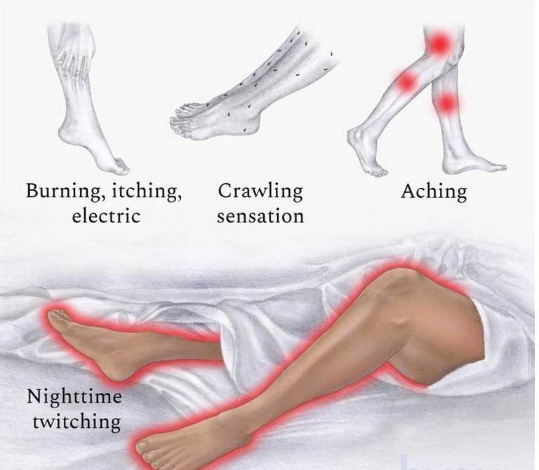 Chart showing the signs and symptoms of restless leg syndrome.