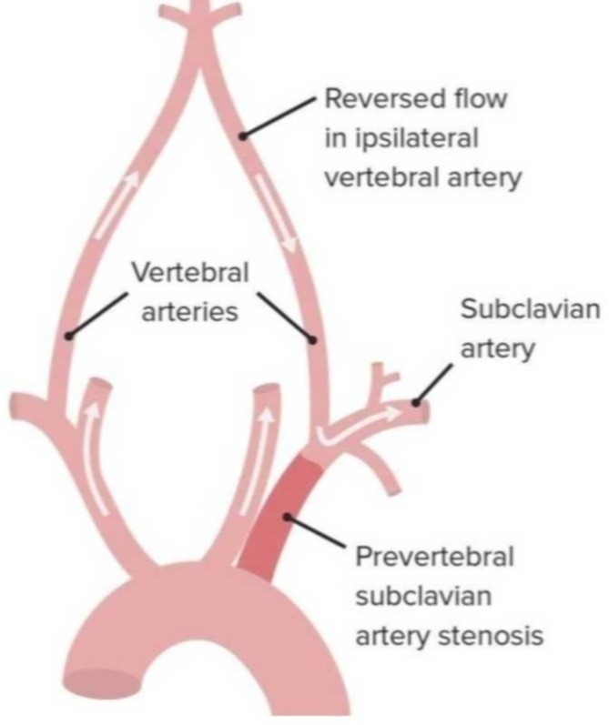 Chart showing subclavian steal syndrome.