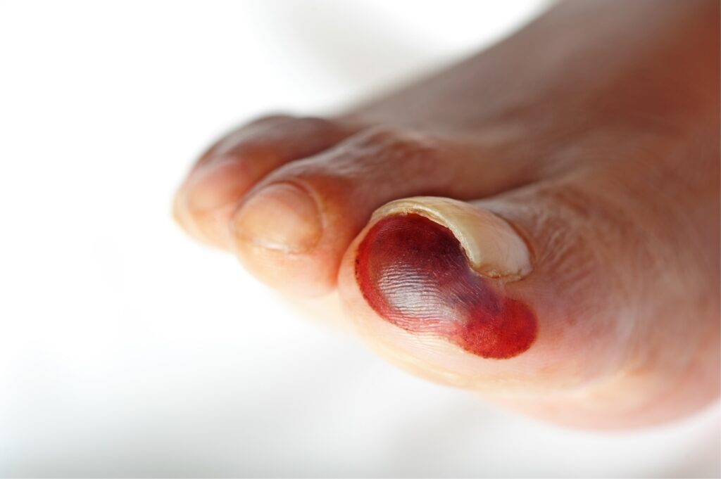 A red ulcer shows on someone's big toe.