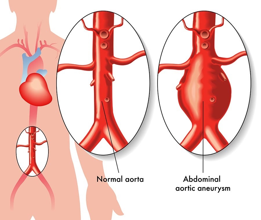 Graphic showing a normal aorta compared to an abdominal aortic aneurysm.