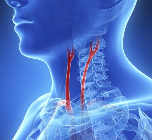 Health Tips to Help Prevent Carotid Artery Disease