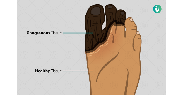 Animated picture of a foot highlighting the difference between healthy tissue and gangrenous tissue.