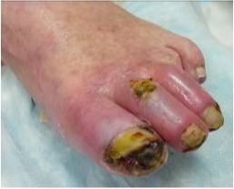 A gangrenous foot.