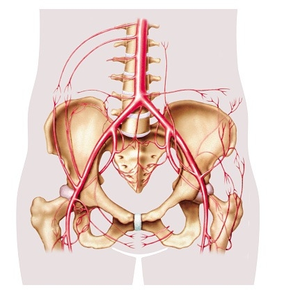Animated arterial view of the pelvic area displaying Leriche Syndrome.