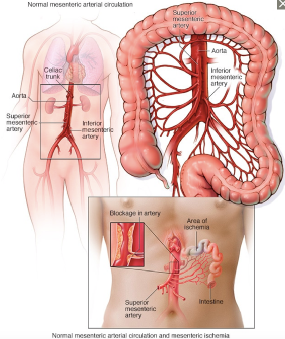 Colored infographic displaying mesenteric ischemia, provided by The Mayo Clinic.