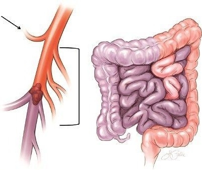Animation of intestines showing Mesenteric Ichemia.