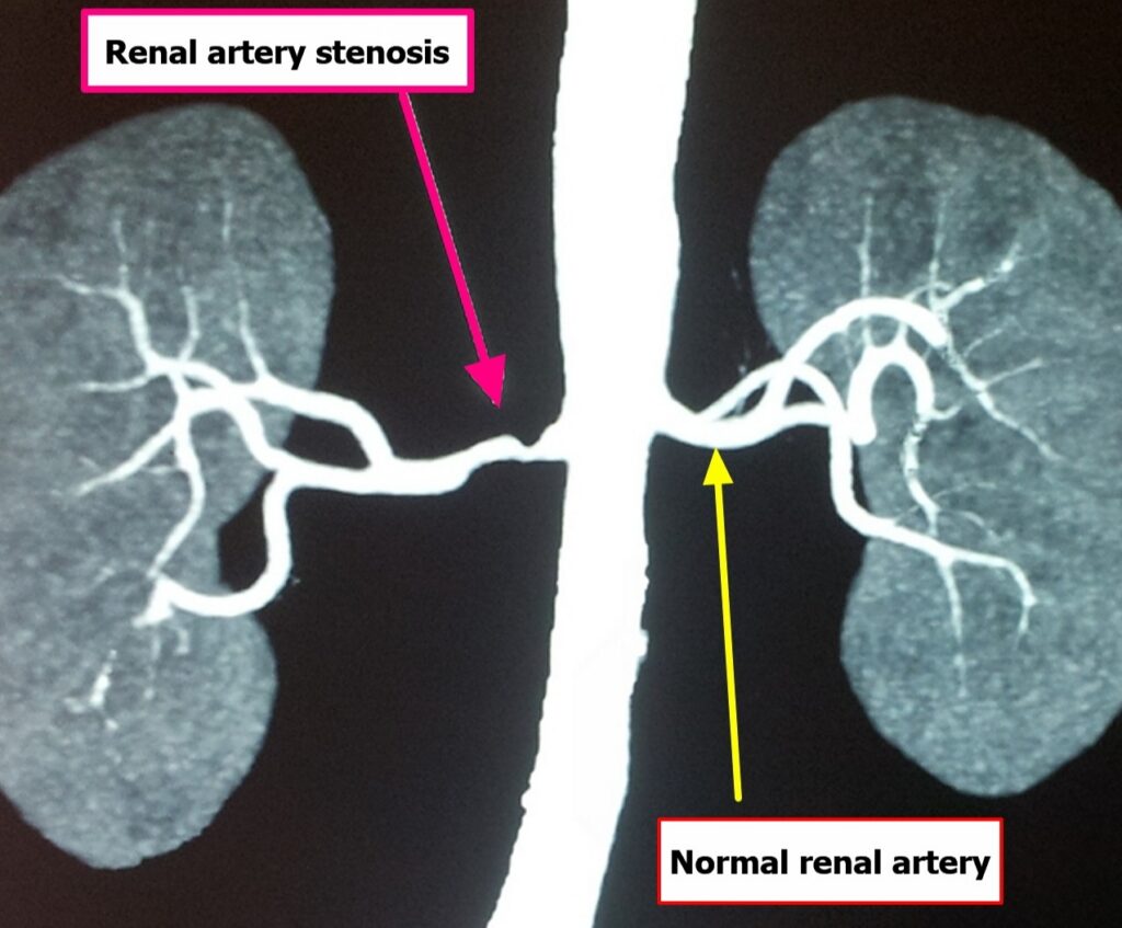 RAS diagram showing RAS vs normal renal artery.