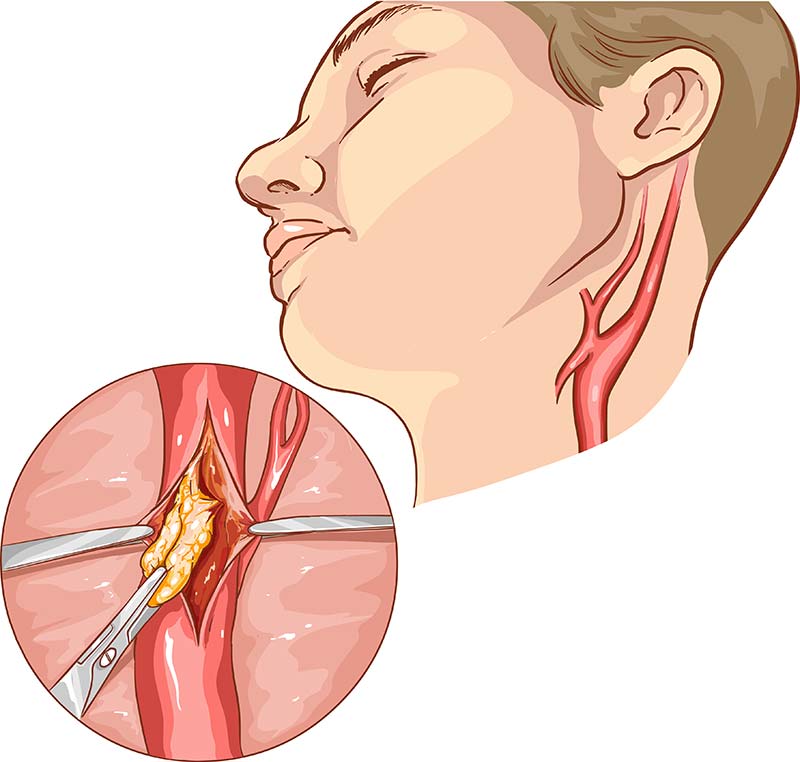 Animation of a carotid endarterectomy.