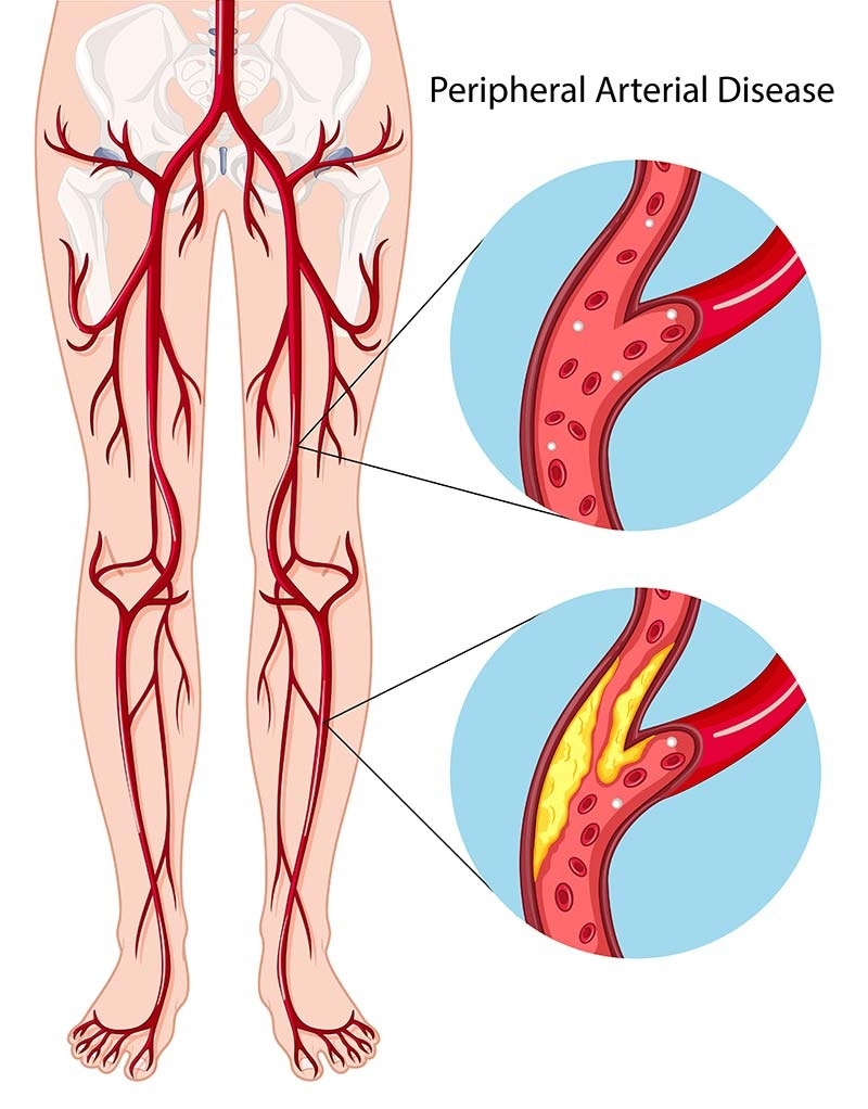 PAD animated view of veins in legs.