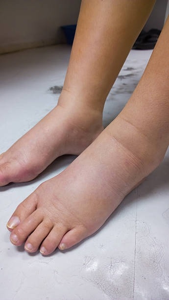 Close-up of a foot that's skin is thickened from a person with lymphedema.