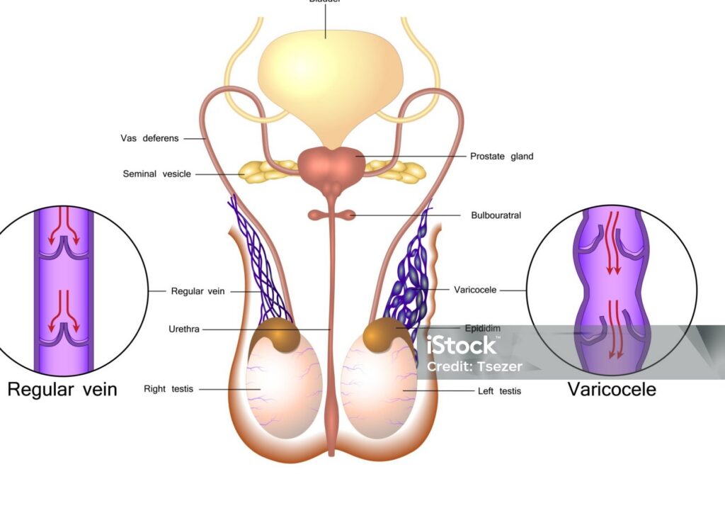 Varicocele in a vein vs a regular, healthy vein, animated.