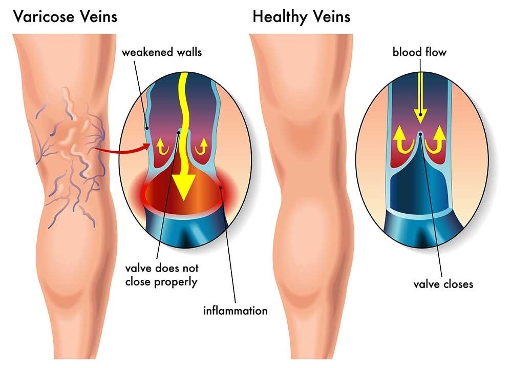 Animated view of the backs of two legs comparing healthy veins to varicose veins.